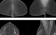 人工智能辅助乳腺癌筛查可以减少不必要的测试